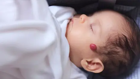 Baby mit einem Hämangiom