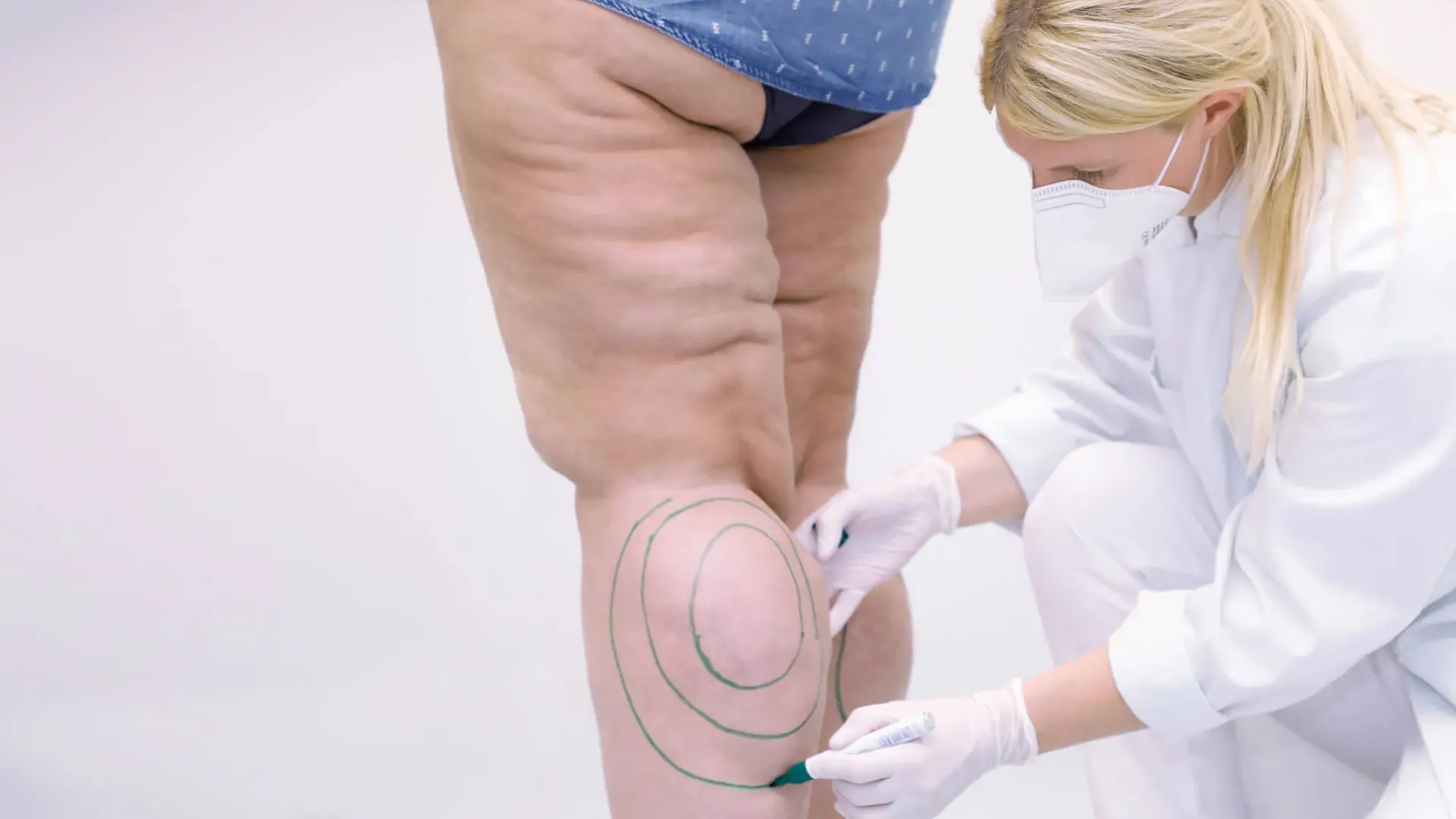 Eine Ärztin der plastischen Chirurgie kennzeichnet den Bereich am Bein einer Patientin die unter Lipödem leidet.