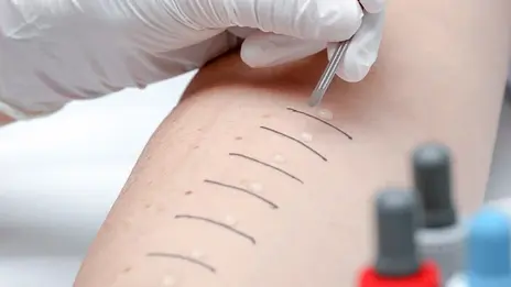 Das Bild zeigt einen Unterarm während des Allergietests.