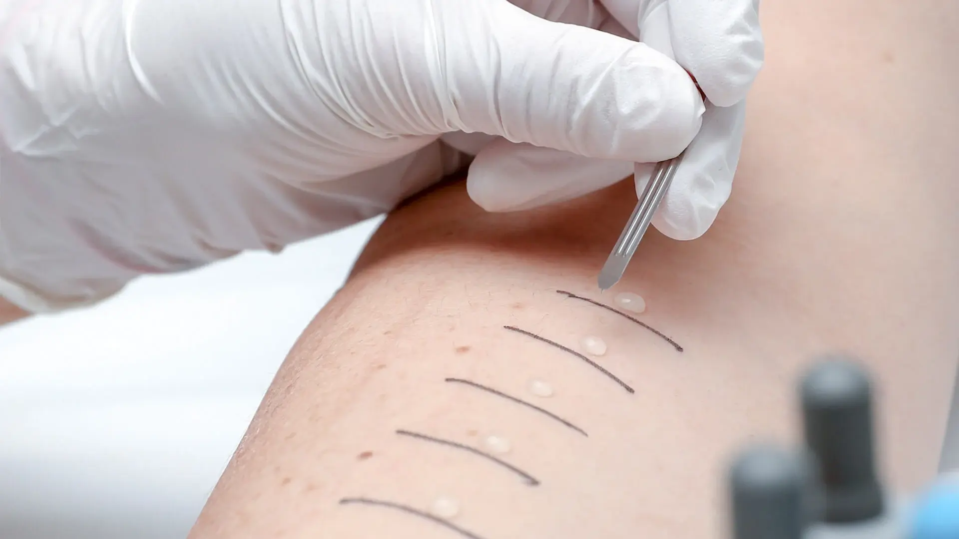 Das Bild zeigt einen Unterarm während des Allergietests.