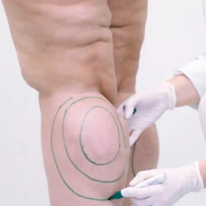 Eine Ärztin der plastischen Chirurgie kennzeichnet den Bereich am Bein einer Patientin die unter Lipödem leidet.