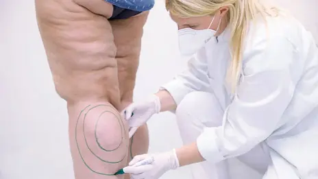 Eine Ärztin der plastischen Chirurgie kennzeichnet den Bereich am Bein einer Patientin die unter Lipödem leidet.