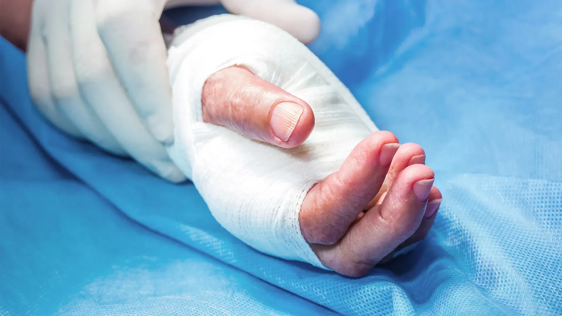 Eine verbundene Hand nach einem chirurgischen Eingriff.